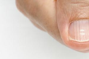 Лечение дистрофия ногтя: фото и причины истончения Дистрофия ногтя лечение